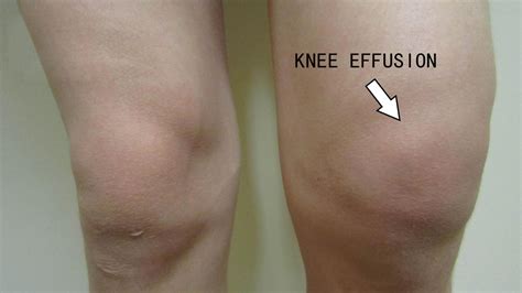 knee effusion lifestyle