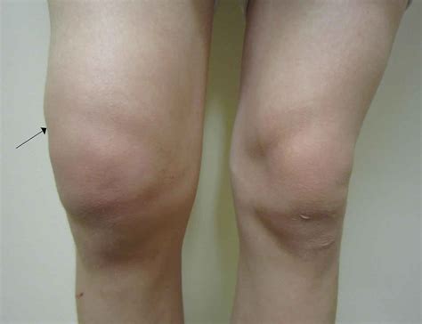 Knee Joint Effusion Causes