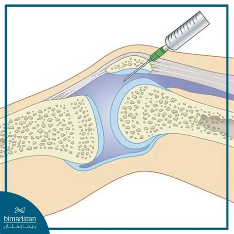 Knee Joint Effusion Management