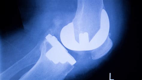 knee replacement surgery