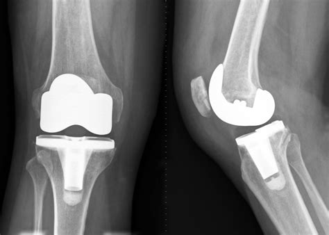 knee replacement surgery