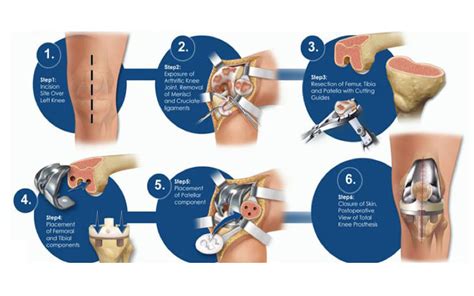 knee replacement surgery steps