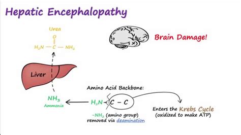 lactulose treating hepatic encephalopathy