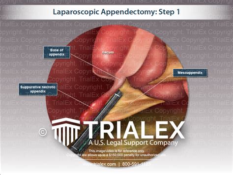 laparoscopic appendectomy