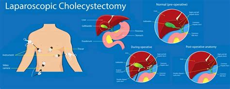 Laparoscopic Cholecystectomy