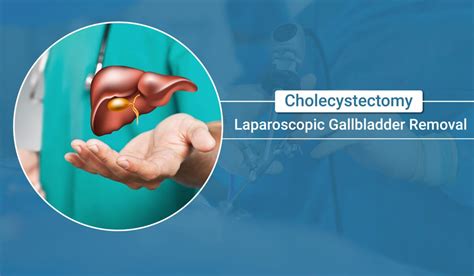 Laparoscopic Gallbladder Surgery FAQs