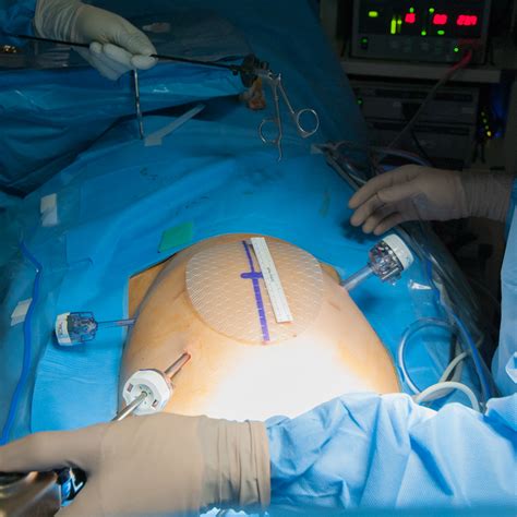 Laparoscopic Hernia Repair