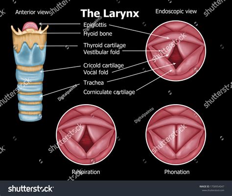 laryngitis