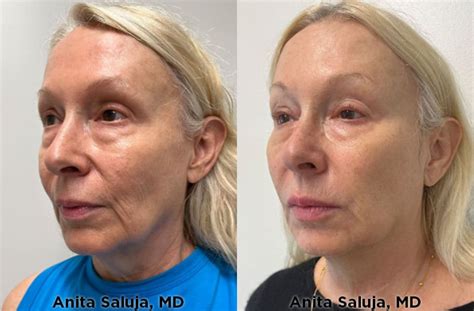 Laser Removal for Moles