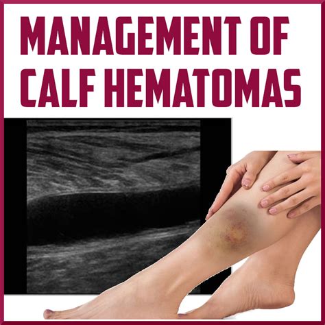 leg hematoma causes