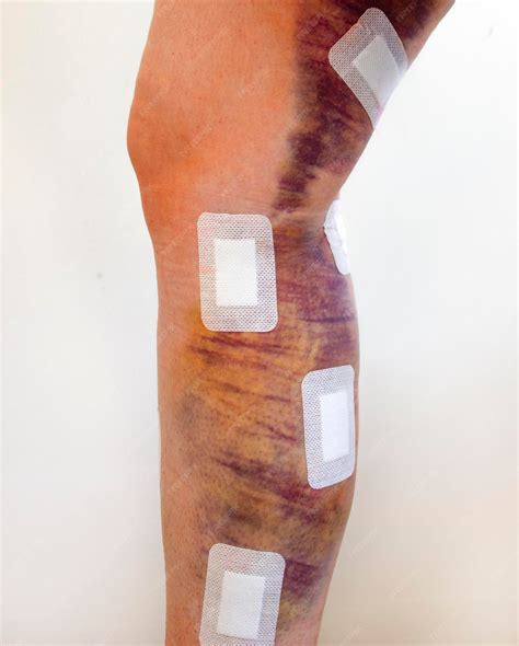 leg hematoma conclusion