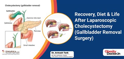 Life After Laparoscopic Gallbladder Surgery