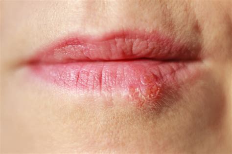 lip sores
