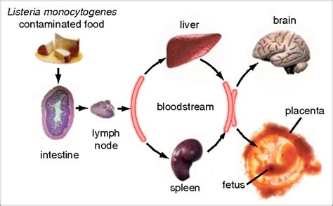 Listeria Infection Causes