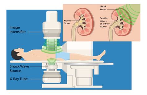 lithotripsy procedure