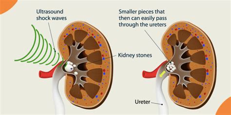 lithotripsy procedure steps