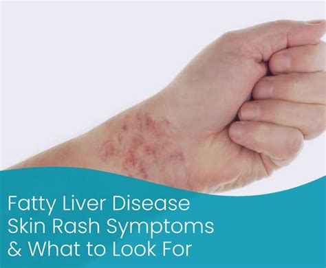 Liver Skin Health