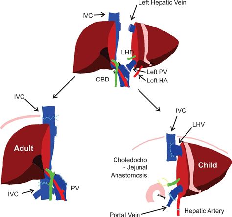 Liver transplantation