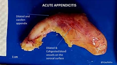 living with appendicitis