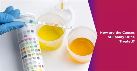 Living with Foamy Urine