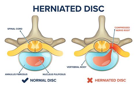 living with herniated disc