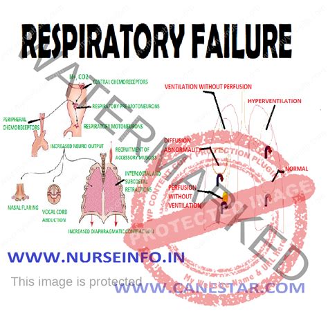 living with respiratory failure