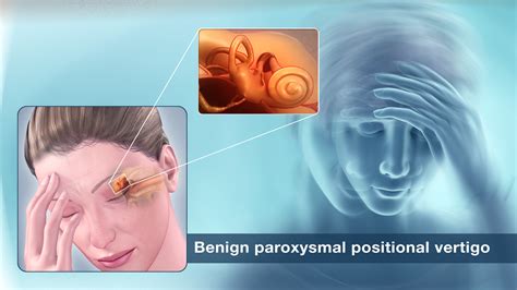 Living with Benign Postural Vertigo