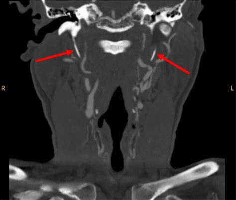 living with carotid dissection illustration