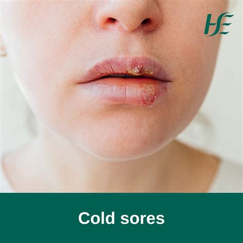 Living with Cold Sores