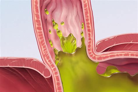 Managing Eosinophilic Esophagitis