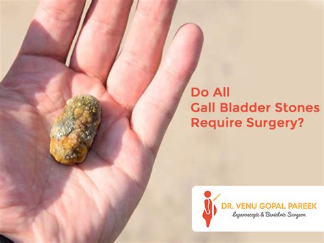 living with gallstones