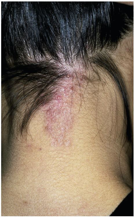 Living with Lichen Simplex Chronicus