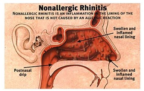 living with non-allergic rhinitis