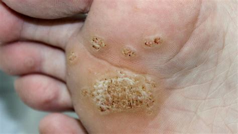 Living with Plantar Warts