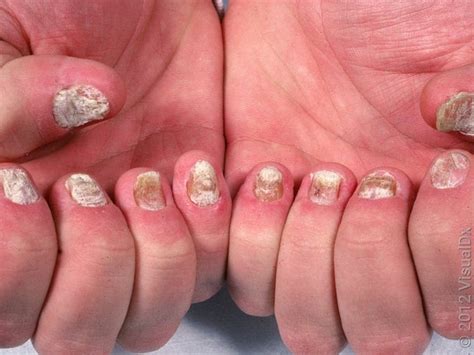 Living with Psoriatic Nail Disease
