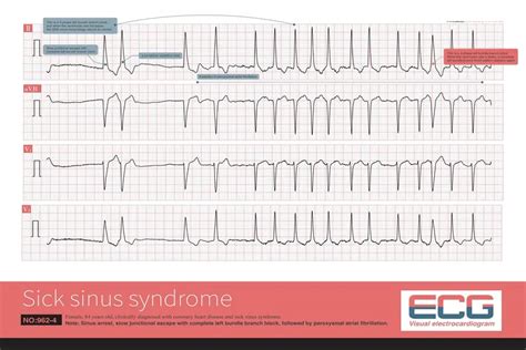 Living with Sick Sinus Syndrome