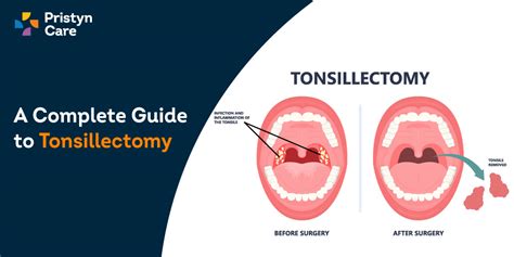Long-term effects of tonsil removal surgery