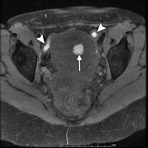 long-term results of endometrial ablation