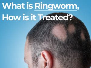 long term ringworm hair