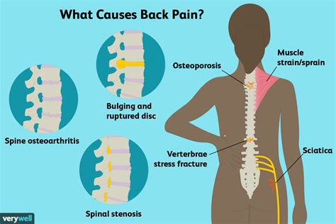 lower back pain during pregnancy
