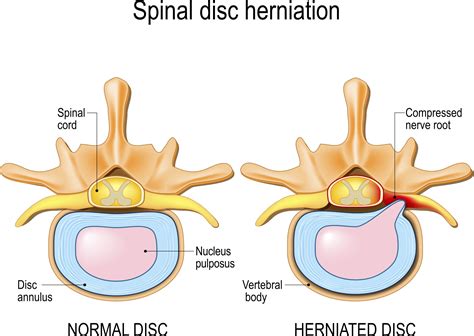 lumbar herniated disc
