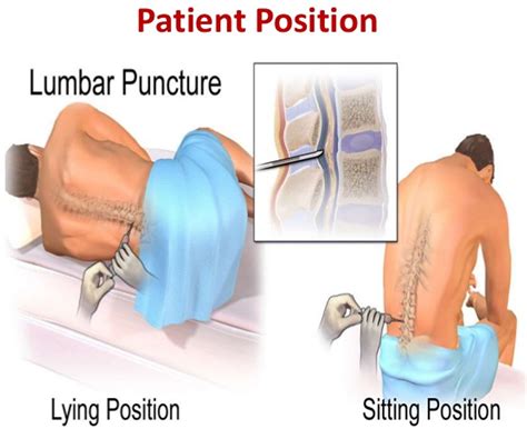 Lumbar Puncture Procedure