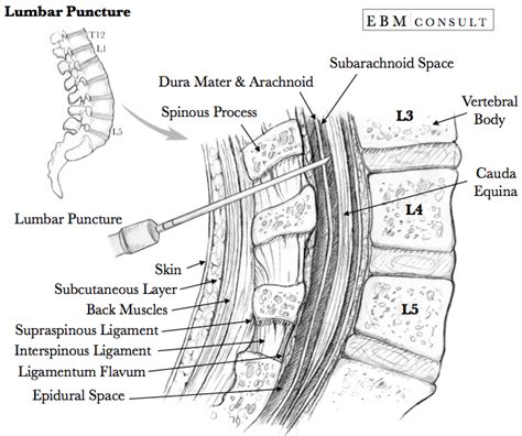 Lumbar Puncture Procedure Overview