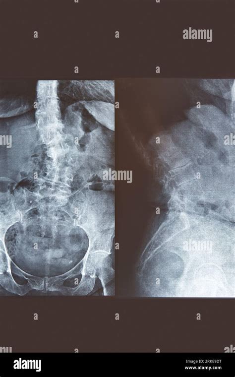 Lumbar Spine X-Ray Diagnosis