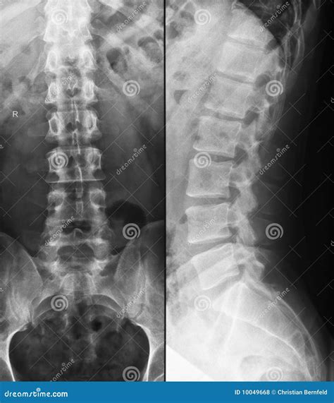 Lumbar Spine X-Ray Procedure