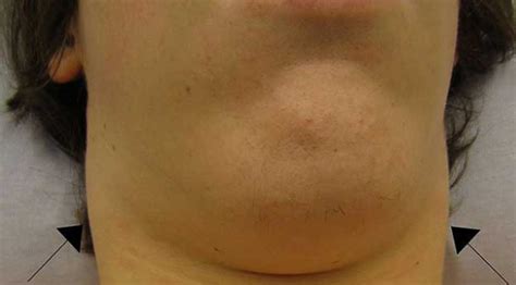 lump under chin