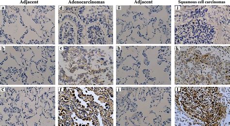 Lung Cancer