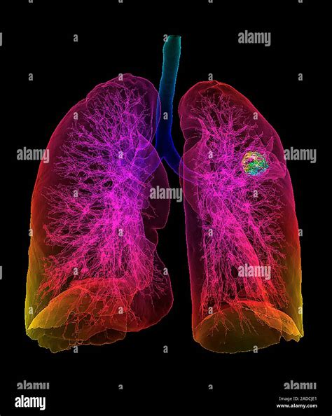 lung cancer