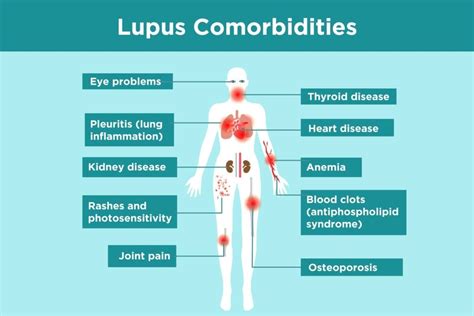 Lupus Complications