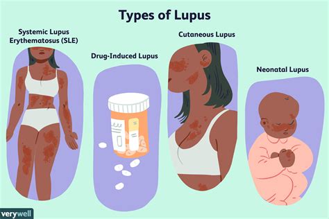 Lupus Condition